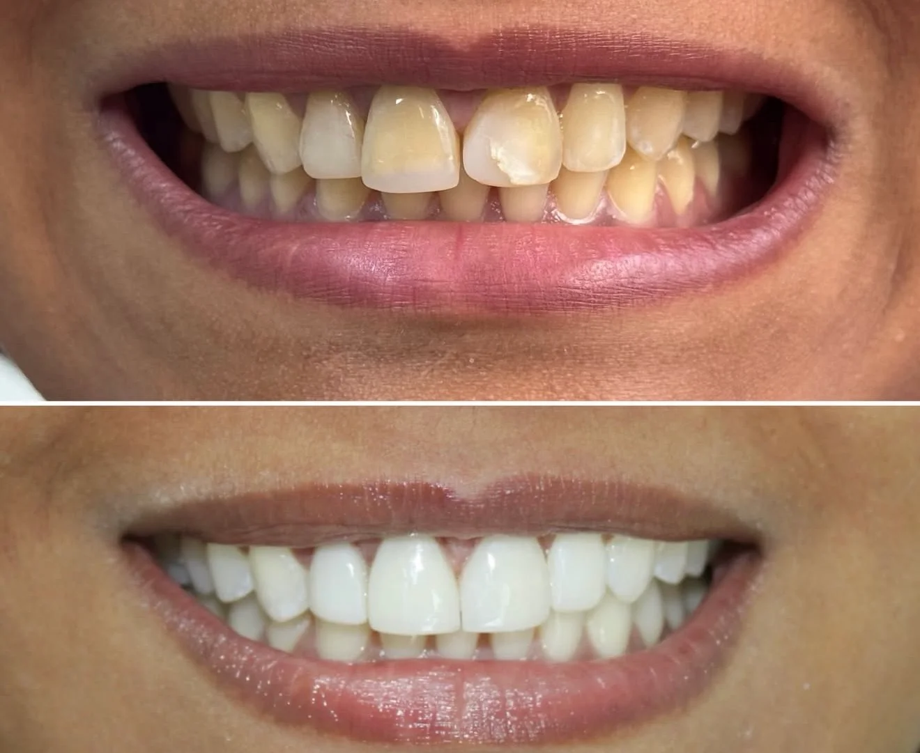 Antes e depois de facetas na ODONTOLIMA Barreiro · caso 6