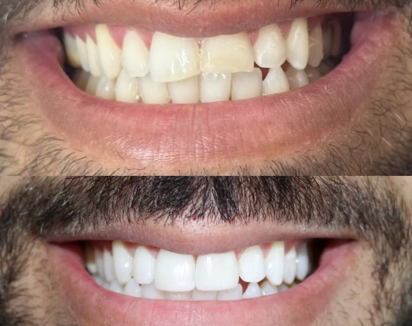 Antes e depois de facetas na ODONTOLIMA Barreiro · caso 5