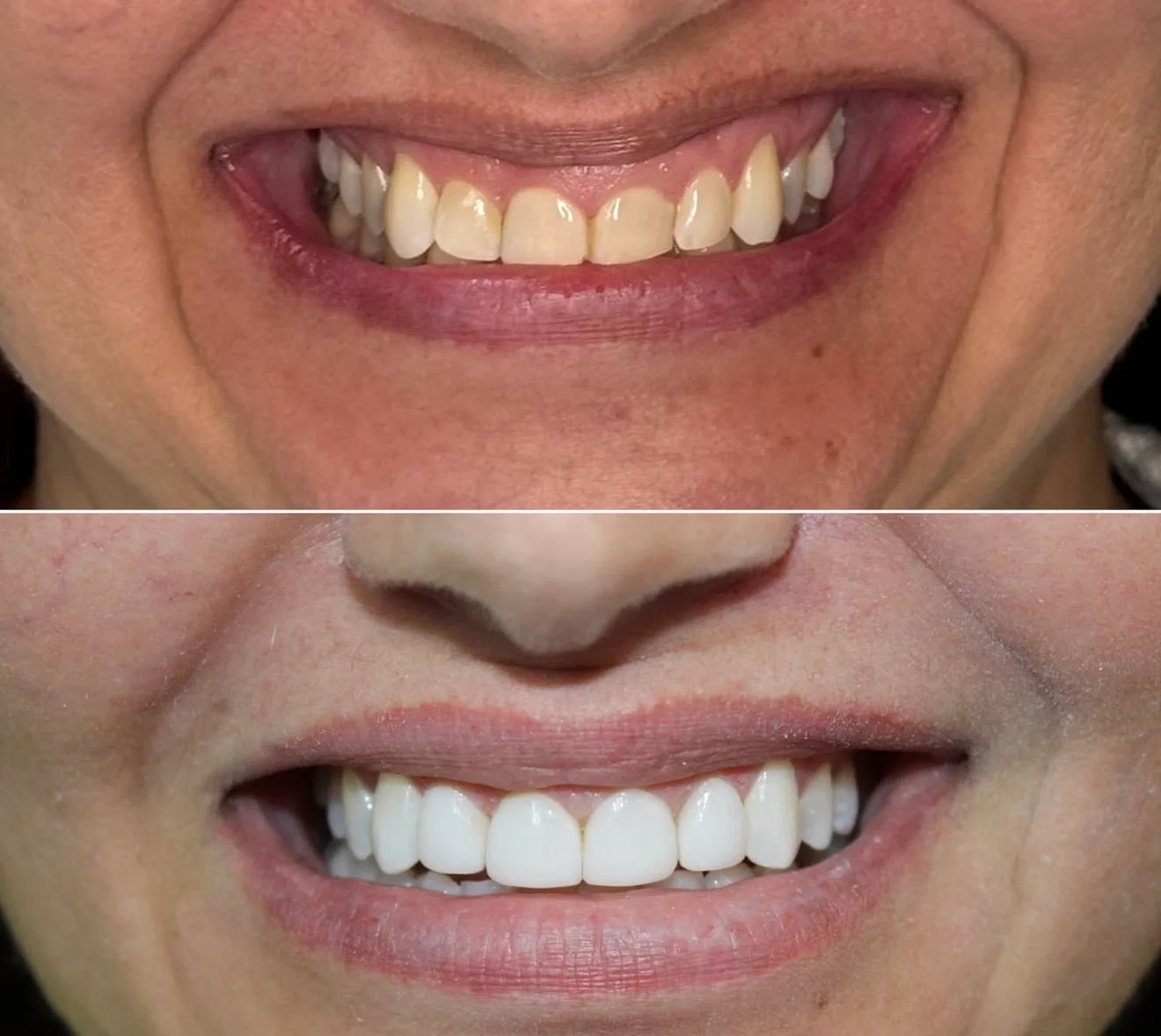 Antes e depois de facetas na ODONTOLIMA Barreiro · caso 4