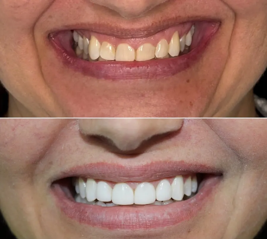 Antes e depois de facetas realizadas na ODONTOLIMA Barreiro