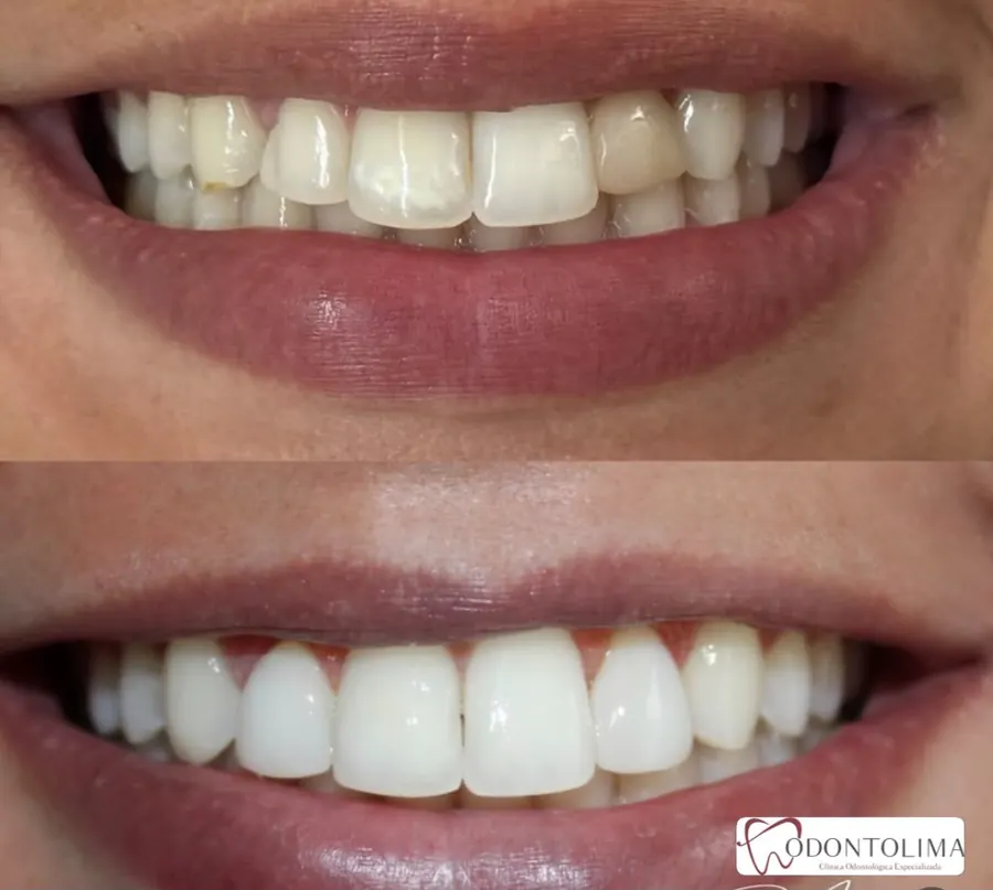 Antes e depois de facetas realizadas na ODONTOLIMA Barreiro