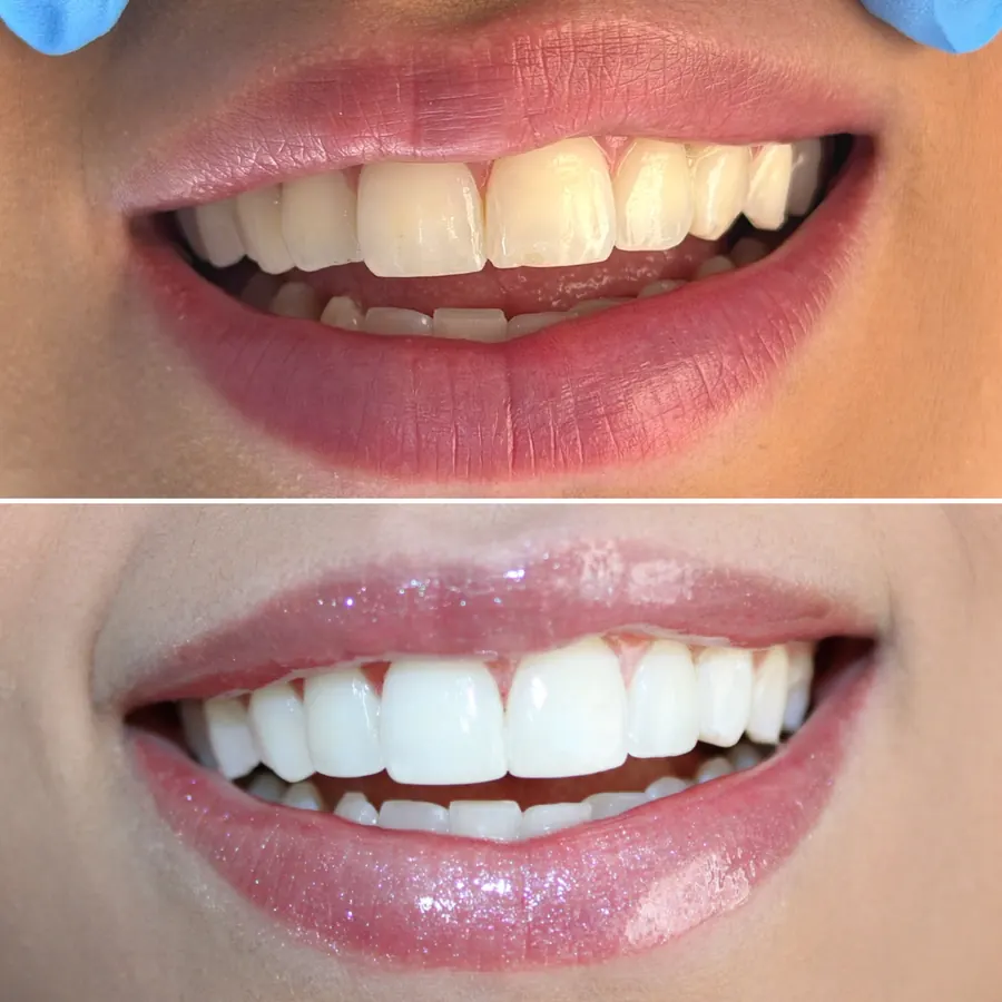 Antes e depois de facetas realizadas na ODONTOLIMA Barreiro